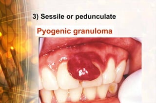 3) Sessile or pedunculate

 Pyogenic granuloma
 