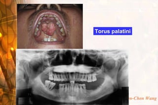 Torus palatini




           Wen-Chen Wang
 