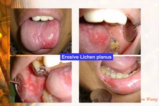 Erosive Lichen planus




                        Wen-Chen Wang
 