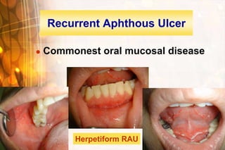 Recurrent Aphthous Ulcer

   Commonest oral mucosal disease




         Herpetiform RAU    Wen-Chen Wang
 