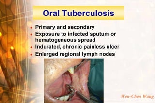 Oral Tuberculosis
   Primary and secondary
   Exposure to infected sputum or
    hematogeneous spread
   Indurated, chronic painless ulcer
   Enlarged regional lymph nodes




                                        Wen-Chen Wang
 
