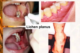 Lichen planus
 