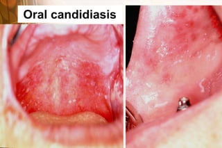 Oral candidiasis
 