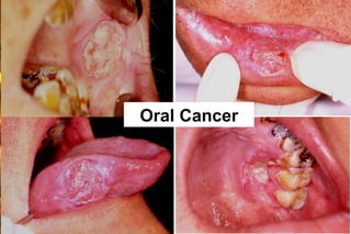 Oral Cancer




              Wen-Chen Wang
 