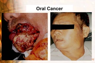 Oral Cancer




              Wen-Chen Wang
 