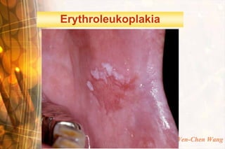 Erythroleukoplakia




                     Wen-Chen Wang
 