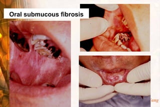 Oral submucous fibrosis




                          Wen-Chen Wang
 