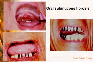 Oral submucous fibrosis




             Wen-Chen Wang
 