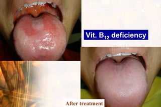 Vit. B12 deficiency




                    Wen-Chen Wang
After treatment
 