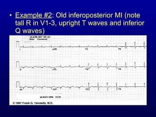 Inferoposterior Infarction 7th part ECG Basics: ECG changes in IHD Dr Salah Mabrouk | PPT