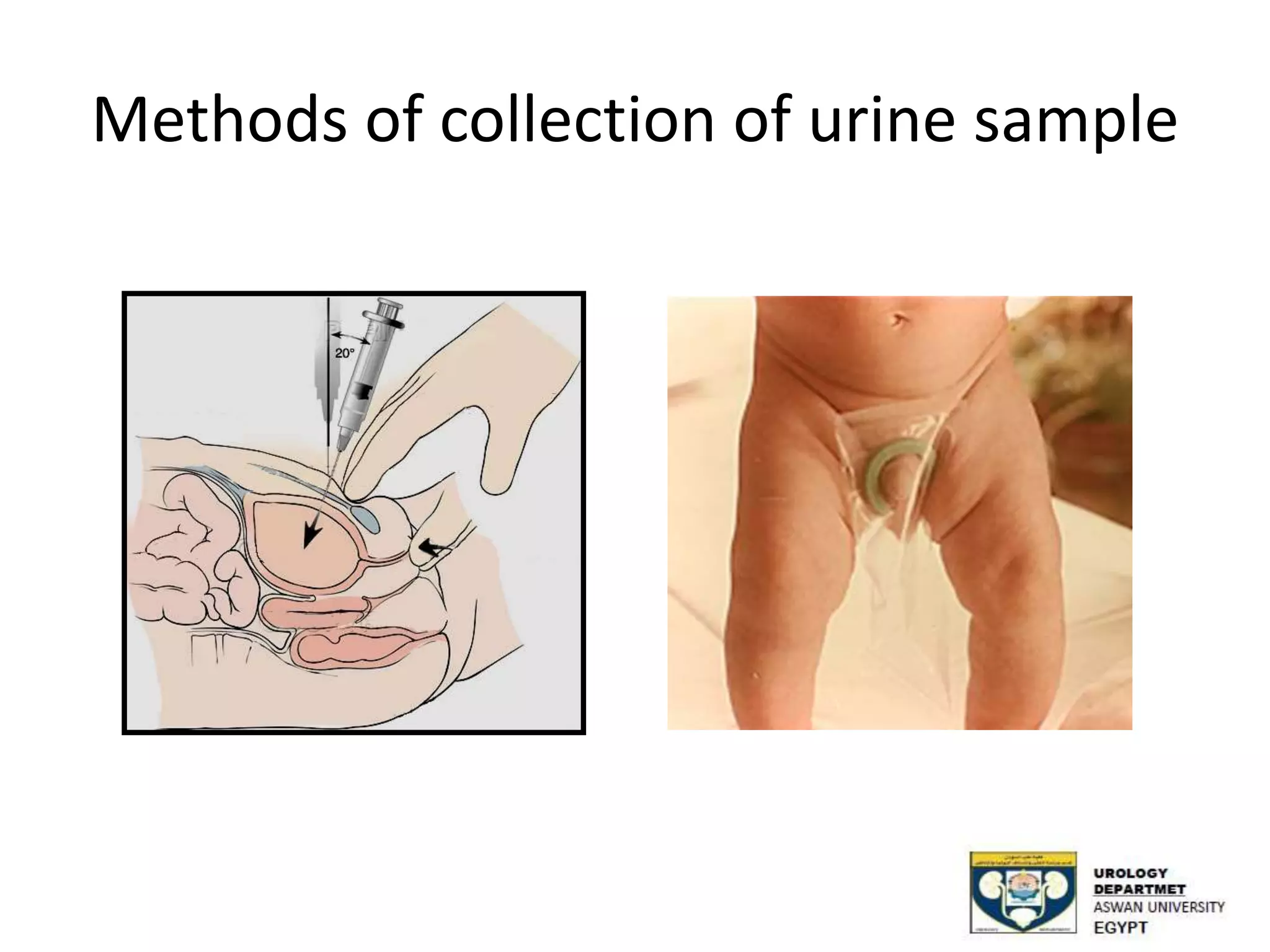 Methods of collection of urine sample
 