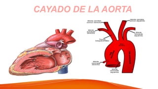 CAYADO DE LA AORTA
 