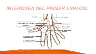 INTEROSEA DEL PRIMER ESPACIO
Interósea del primer
espacio
 