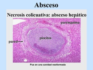 Absceso
Pus en una cavidad neoformada
 