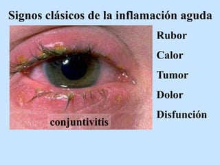 Signos clásicos de la inflamación aguda
Rubor
Calor
Tumor
Dolor
Disfunción
conjuntivitis
 