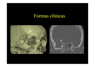 Formas clínicas
 