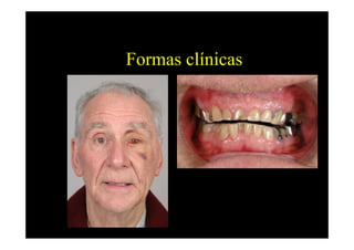 Formas clínicas
 
