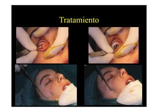 Tratamiento
 