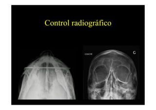 Control radiográfico
 