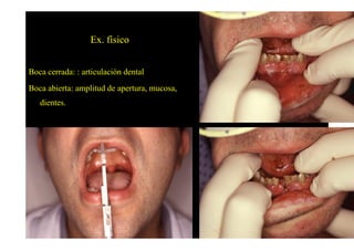 Ex. físico


Boca cerrada: : articulación dental
Boca abierta: amplitud de apertura, mucosa,
   dientes.
 