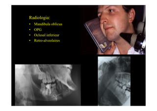 Radiologia:
•    Mandíbula oblícua
•    OPG
•    Oclusal inferieur
•    Retro-alveolaires
 