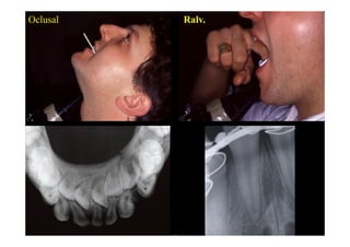 Oclusal                         Ralv.
  • III. Imagerie
   : mandibule
          orthopantomographie
          Dautrey, Bonneau
          mordu, rétro
 