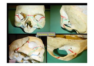 Fracturas lefort
 