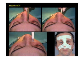 Tratamiento
 