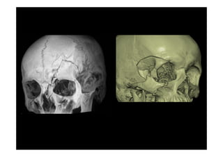 6 traumatismos faciales