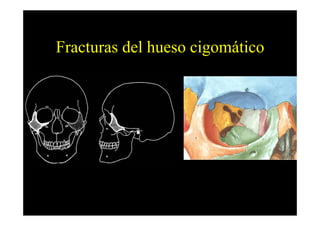 Fracturas del hueso cigomático
 