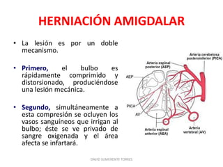HERNIACIÓN AMIGDALAR
• La lesión es por un doble
mecanismo.
• Primero, el bulbo es
rápidamente comprimido y
distorsionado, produciéndose
una lesión mecánica.
• Segundo, simultáneamente a
esta compresión se ocluyen los
vasos sanguíneos que irrigan al
bulbo; éste se ve privado de
sangre oxigenada y el área
afecta se infartará.
DAVID SUMERENTE TORRES
 