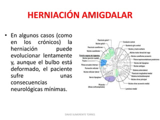 HERNIACIÓN AMIGDALAR
• En algunos casos (como
en los crónicos) la
herniación puede
evolucionar lentamente
y, aunque el bulbo está
deformado, el paciente
sufre unas
consecuencias
neurológicas mínimas.
DAVID SUMERENTE TORRES
 