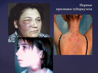 ПервыеПервые
признаки туберкулезапризнаки туберкулеза
 