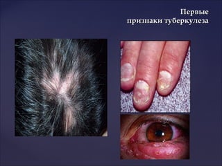 ПервыеПервые
признаки туберкулезапризнаки туберкулеза
 