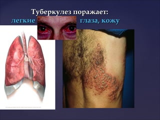 Туберкулез поражает:Туберкулез поражает:
легкие глаза, кожулегкие глаза, кожу
 