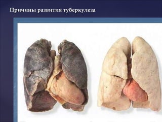 Причины развития туберкулезаПричины развития туберкулеза
 