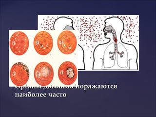 Органы дыхания поражаютсяОрганы дыхания поражаются
наиболее частонаиболее часто
 