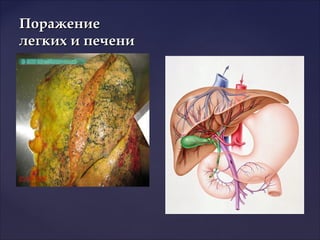 ПоражениеПоражение
легких и печенилегких и печени
 