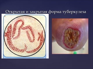 Открытая и закрытая форма туберкулезаОткрытая и закрытая форма туберкулеза
 