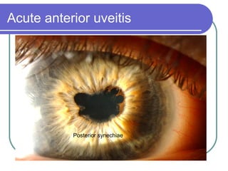 Acute anterior uveitis
Posterior synechiae
 