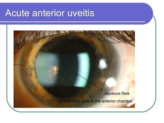 Uveitis