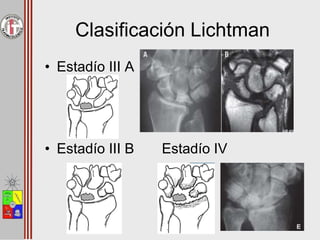 Clasificación Lichtman
• Estadío III A
• Estadío III B Estadío IV
 