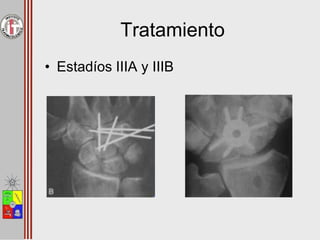 Tratamiento
• Estadíos IIIA y IIIB
 