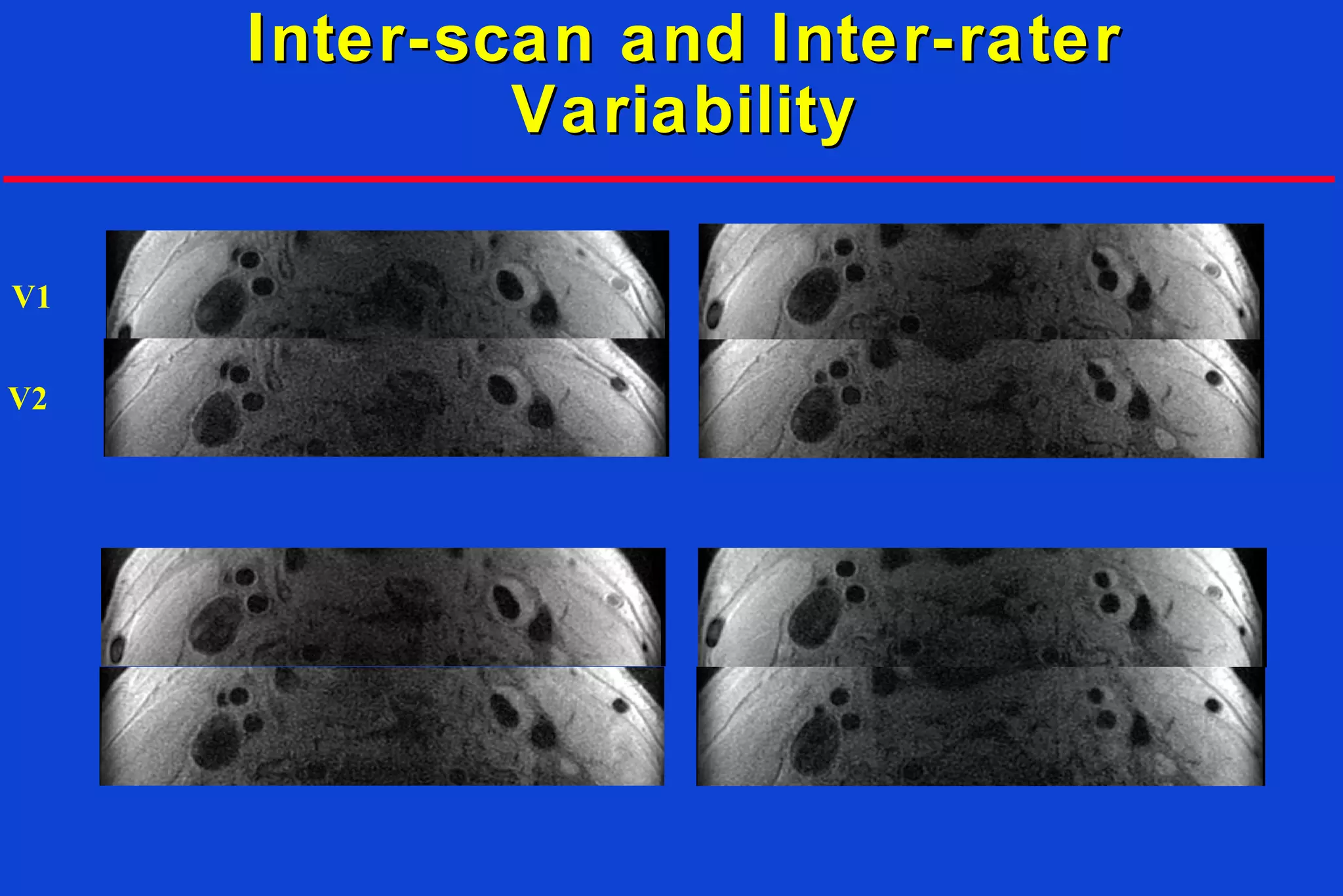 Inter-scan and Inter-raterInter-scan and Inter-rater
VariabilityVariability
V1
V2
 