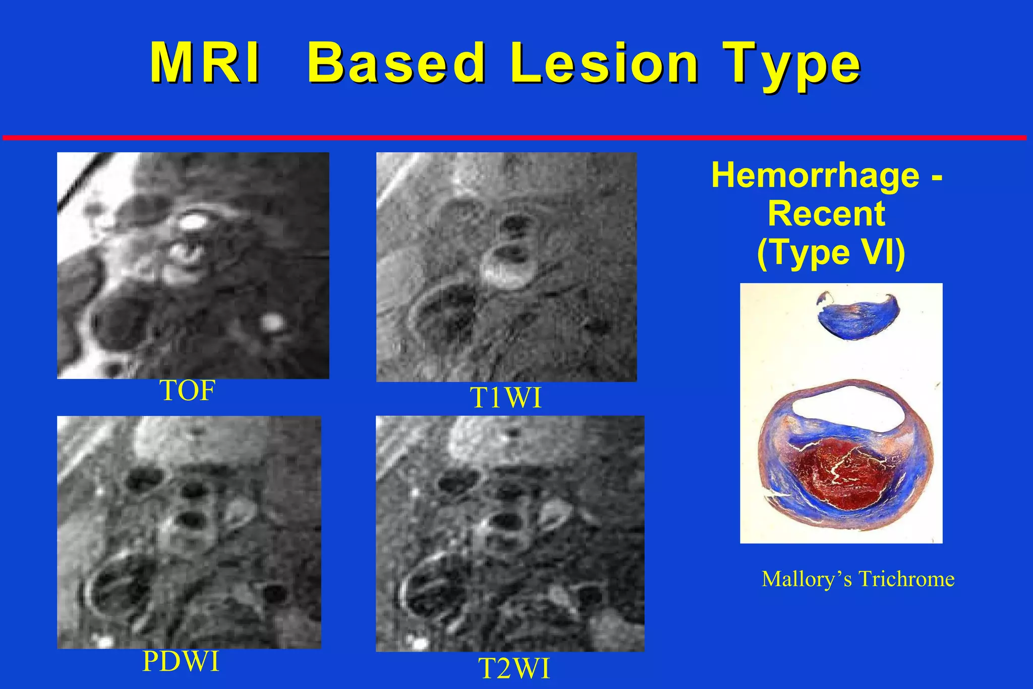 Hemorrhage -
Recent
(Type VI)
TOF T1WI
PDWI T2WI
Mallory’s Trichrome
MRI Based Lesion TypeMRI Based Lesion Type
 