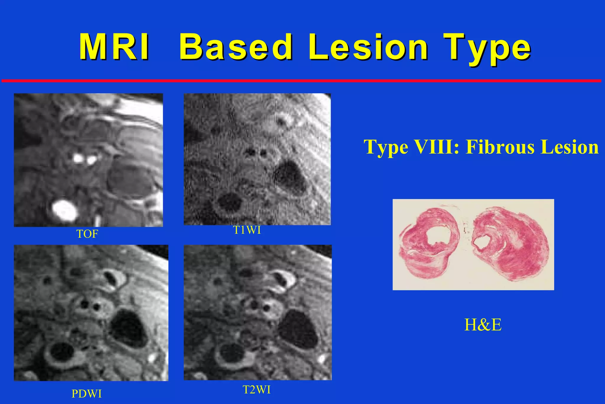 MRI Based Lesion TypeMRI Based Lesion Type
TOF T1WI
PDWI T2WI
H&E
Type VIII: Fibrous Lesion
 