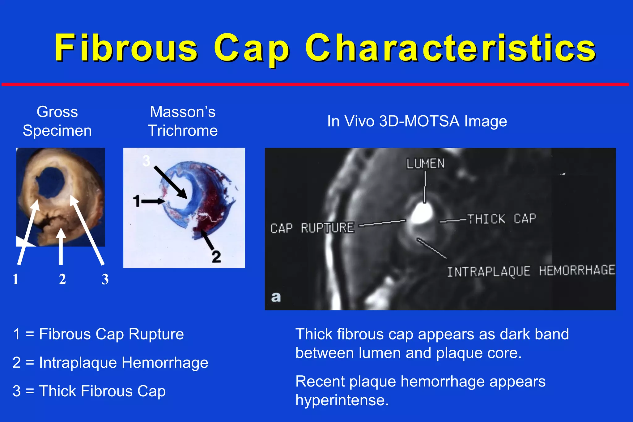 Fibrous Cap CharacteristicsFibrous Cap Characteristics
Gross
Specimen
Masson’s
Trichrome
In Vivo 3D-MOTSA Image
1 32
3
1 = Fibrous Cap Rupture
2 = Intraplaque Hemorrhage
3 = Thick Fibrous Cap
Thick fibrous cap appears as dark band
between lumen and plaque core.
Recent plaque hemorrhage appears
hyperintense.
 