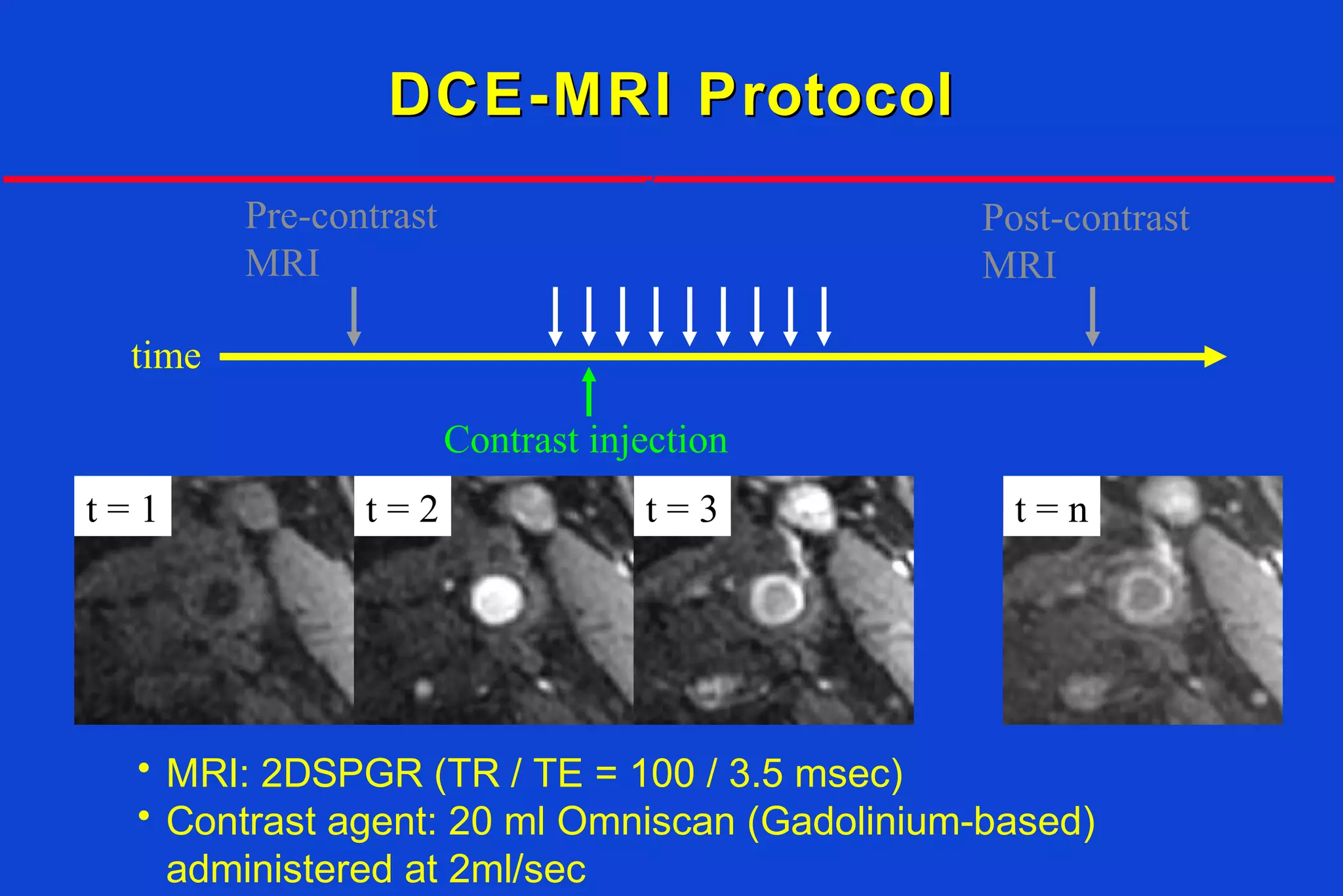 DCE-MRI ProtocolDCE-MRI Protocol
• MRI: 2DSPGR (TR / TE = 100 / 3.5 msec)
• Contrast agent: 20 ml Omniscan (Gadolinium-based)
administered at 2ml/sec
time
~15 sec
Dynamic
MRI
Contrast injection
Pre-contrast
MRI
Post-contrast
MRI
t = 1 t = nt = 3t = 2
...
 