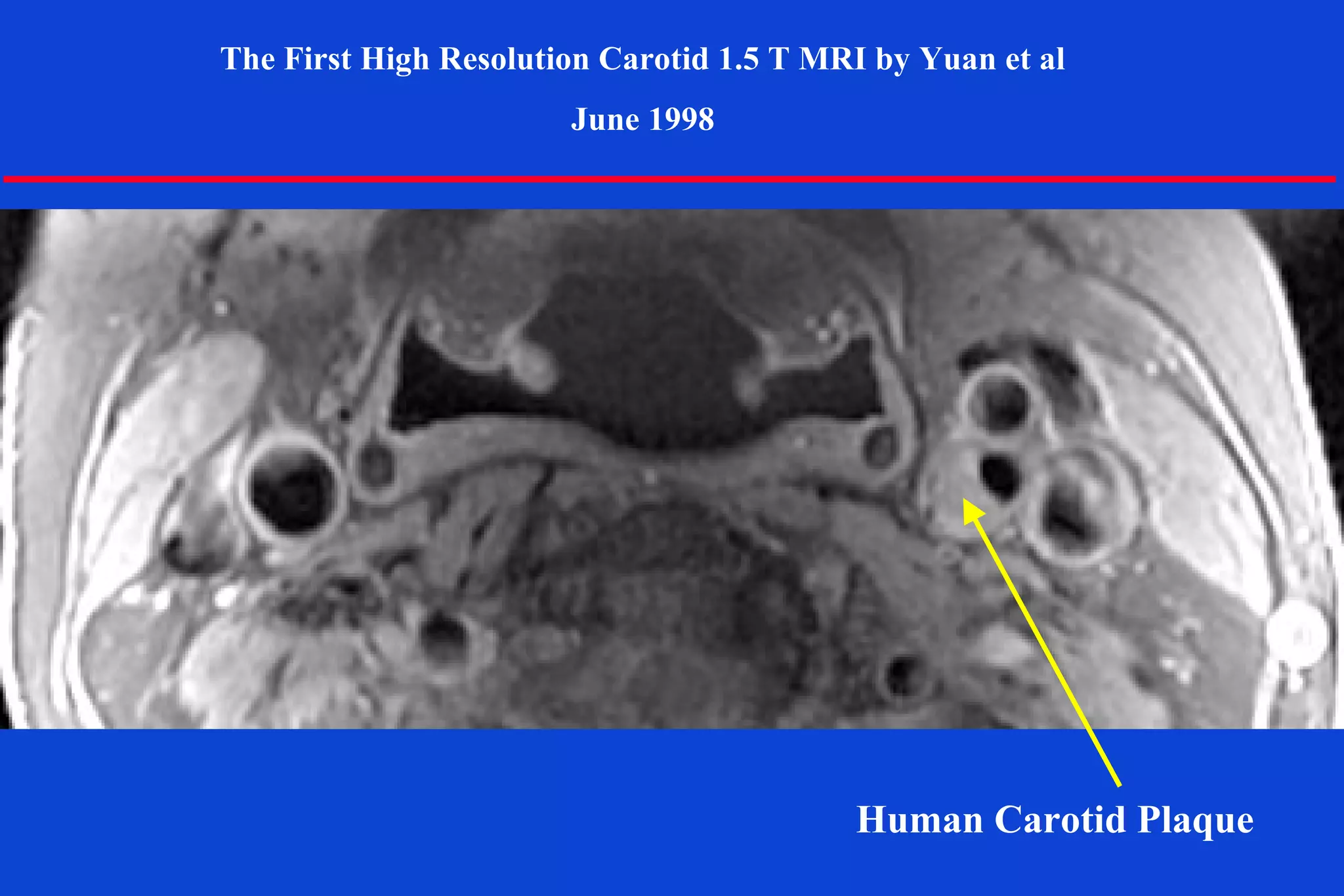 Human Carotid Plaque
The First High Resolution Carotid 1.5 T MRI by Yuan et al
June 1998
 
