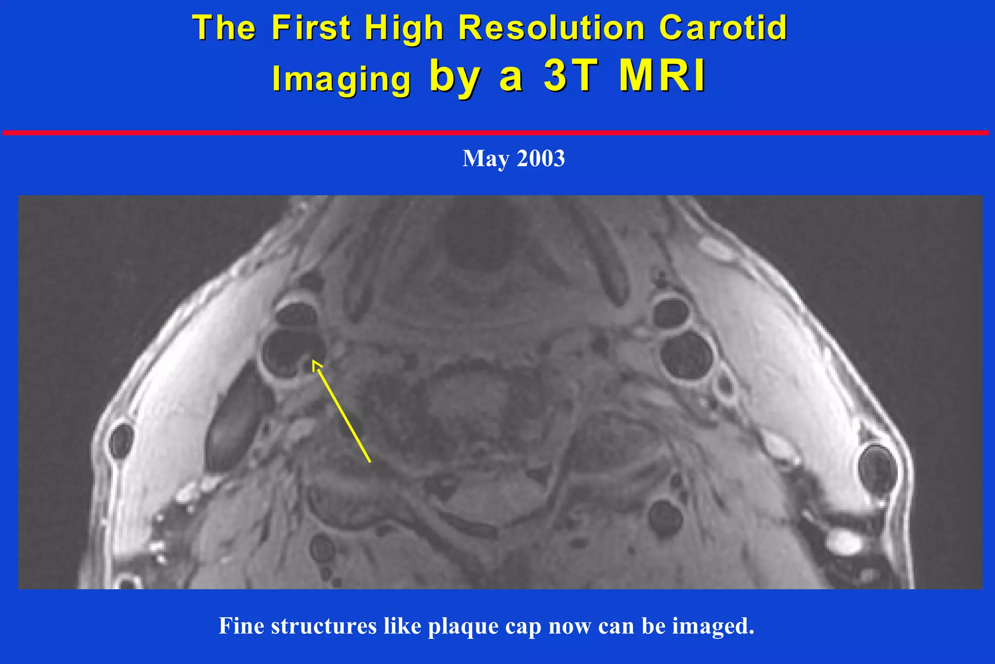 The First High Resolution CarotidThe First High Resolution Carotid
ImagingImaging by a 3T MRIby a 3T MRI
Fine structures like plaque cap now can be imaged.
May 2003
 